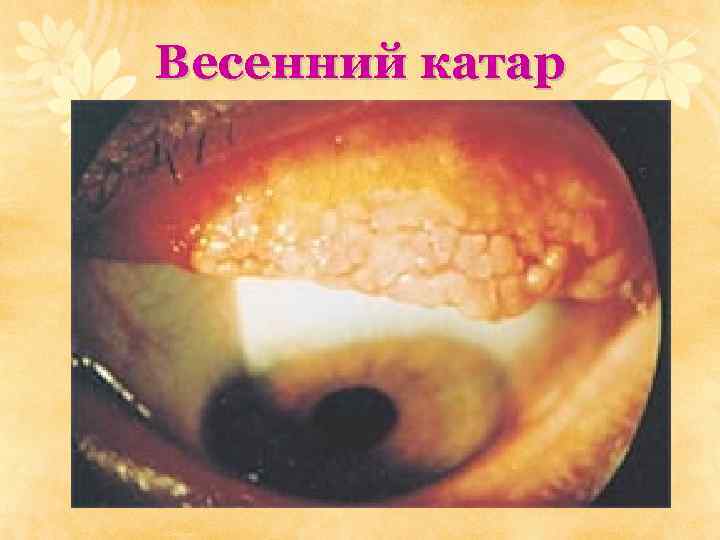 Весенний катар 