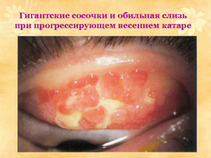 Гигантские сосочки и обильная слизь при прогрессирующем весеннем катаре 
