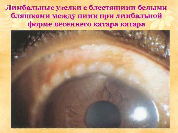 Лимбальные узелки с блестящими белыми бляшками между ними при лимбальной форме весеннего катара 