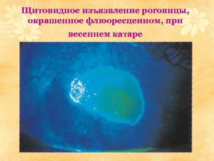 Щитовидное изъязвление роговицы, окрашенное флюоресцеином, при весеннем катаре 