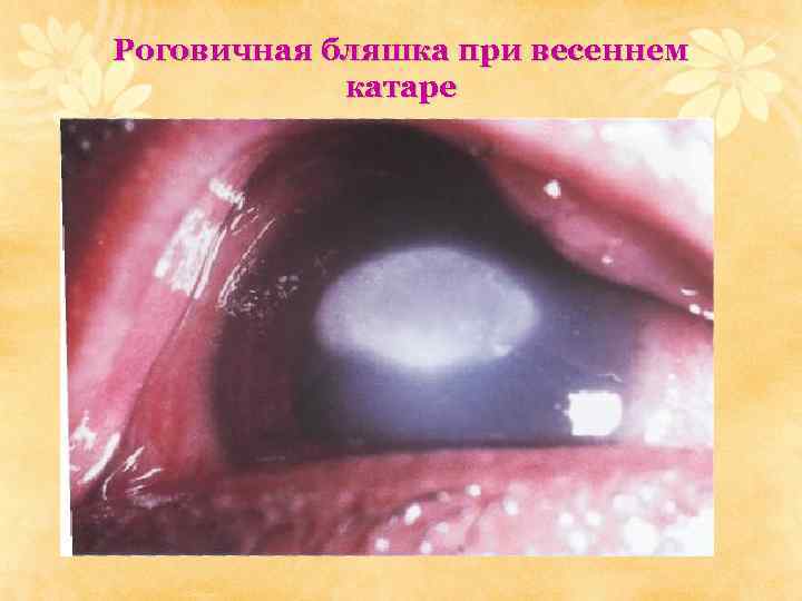 Роговичная бляшка при весеннем катаре 