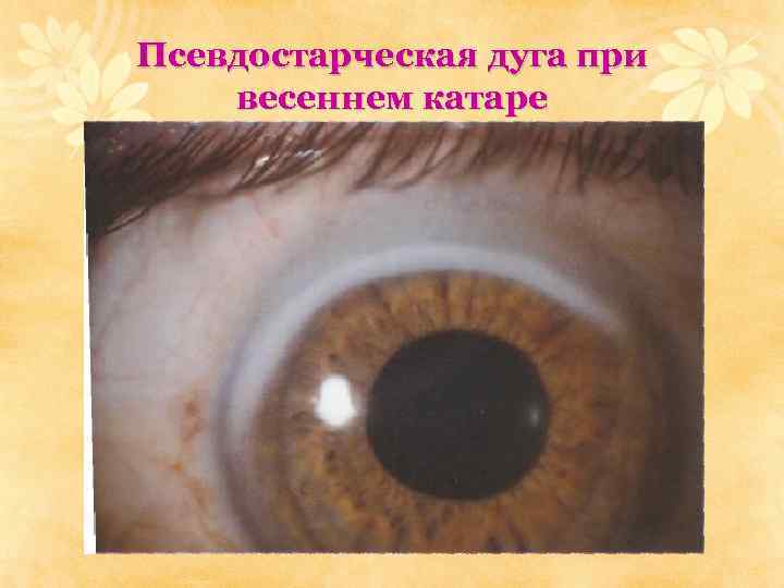 Псевдостарческая дуга при весеннем катаре 