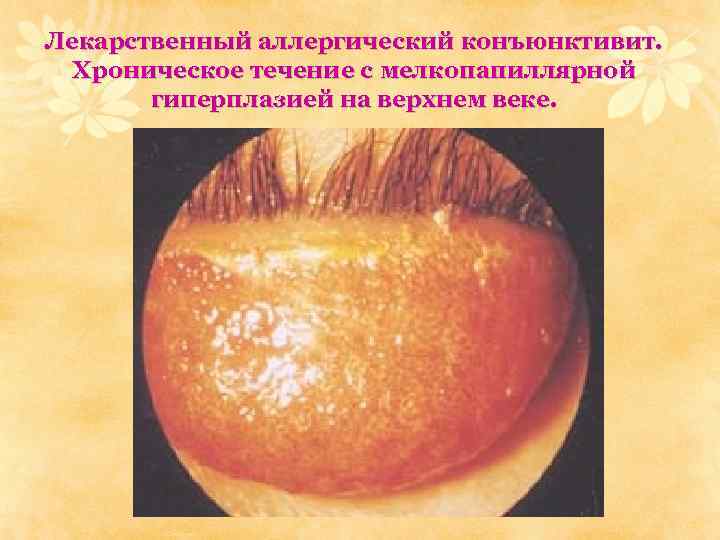 Лекарственный аллергический конъюнктивит. Хроническое течение с мелкопапиллярной гиперплазией на верхнем веке. 