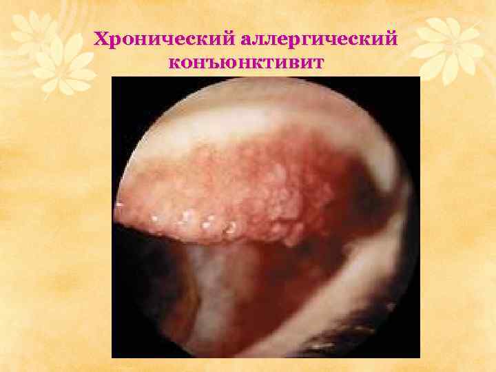 Хронический аллергический конъюнктивит 