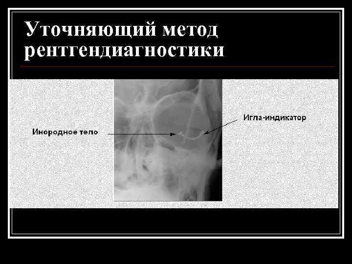 Уточняющий метод рентгендиагностики 