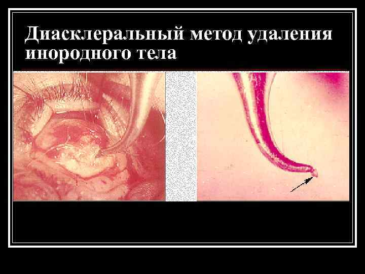 Диасклеральный метод удаления инородного тела 