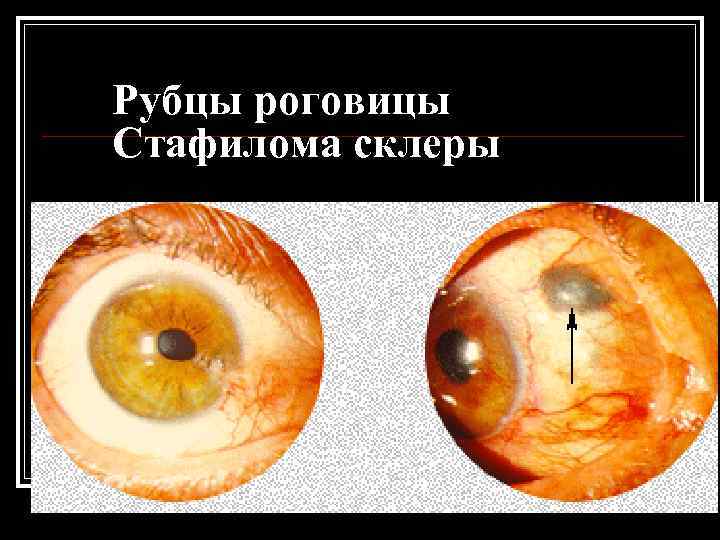 Рубцы роговицы Стафилома склеры 