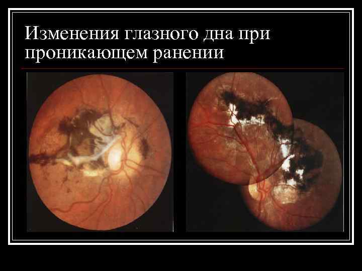 Изменения глазного дна при проникающем ранении 