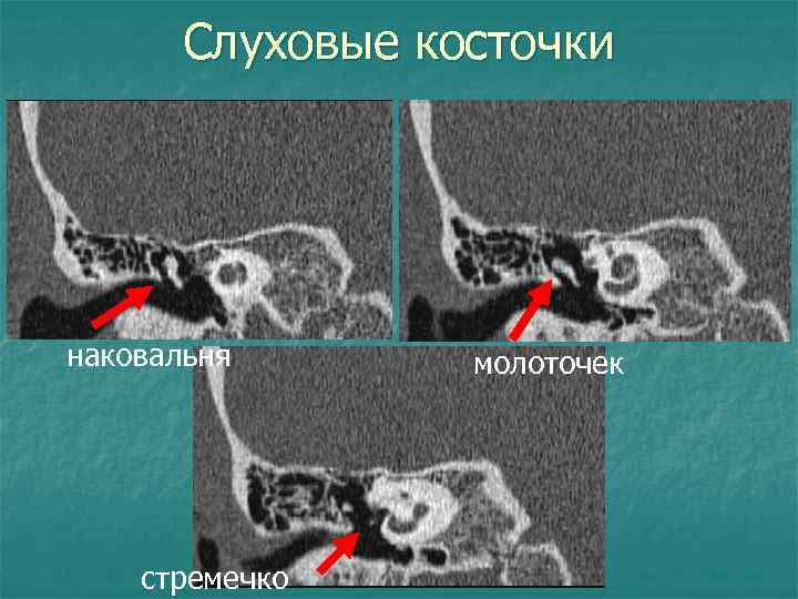 Слуховые косточки наковальня стремечко молоточек 