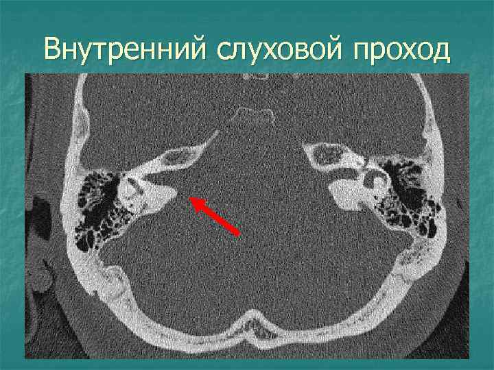 Внутренний слуховой проход 