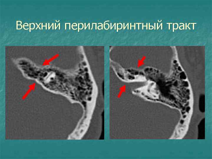 Верхний перилабиринтный тракт 