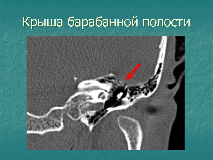 Крыша барабанной полости 