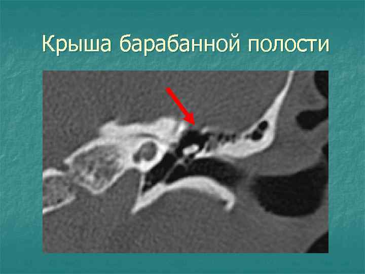 Крыша барабанной полости 