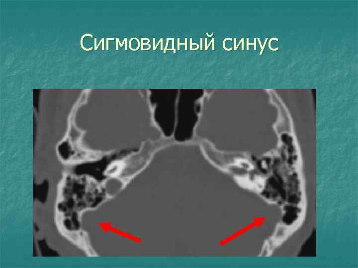 Сигмовидный синус 