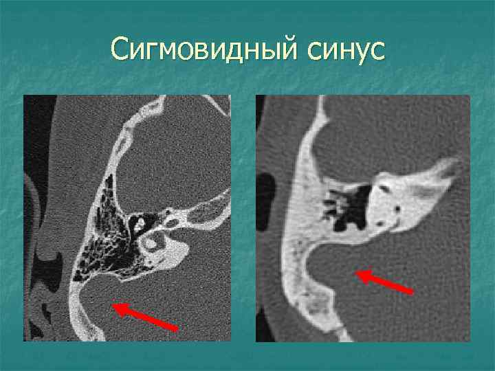 Сигмовидный синус 