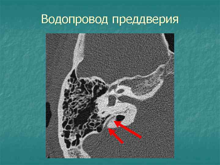 Водопровод преддверия 