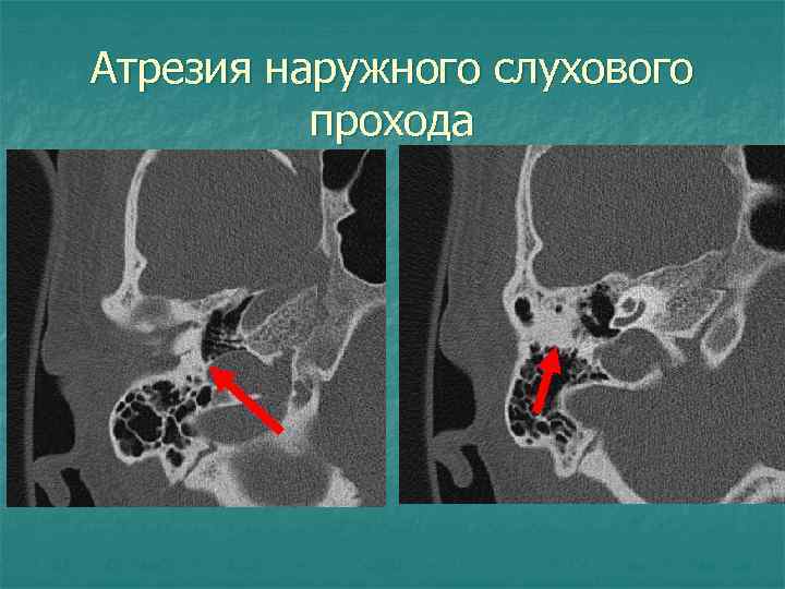 Атрезия наружного слухового прохода 