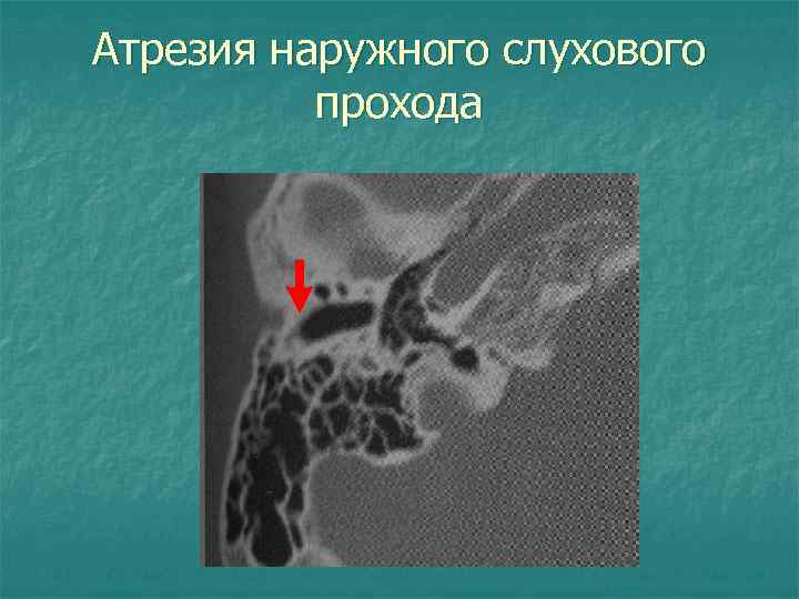 Атрезия наружного слухового прохода 