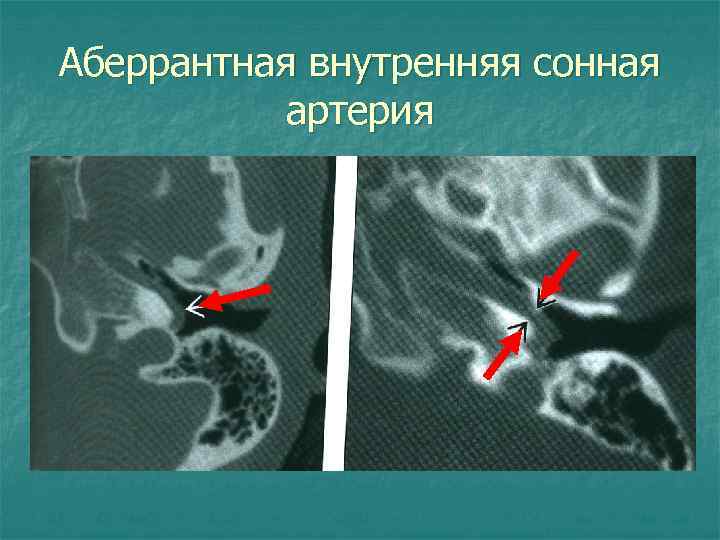 Аберрантная внутренняя сонная артерия 