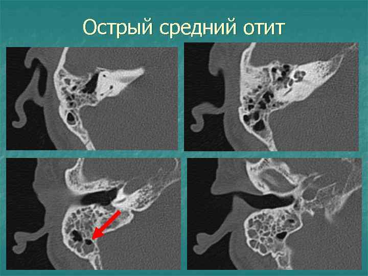 Острый средний отит 