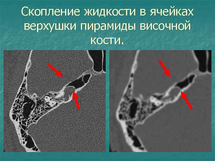 По изображению с микроскопа в препарате среза пирамиды височной кости видны пространства