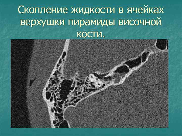 Скопление жидкости в ячейках верхушки пирамиды височной кости. 