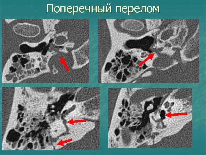 Поперечный перелом 