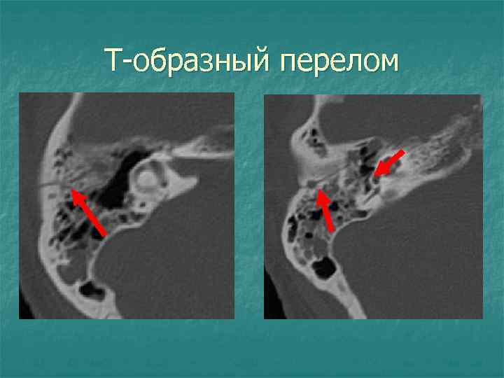 Т-образный перелом 