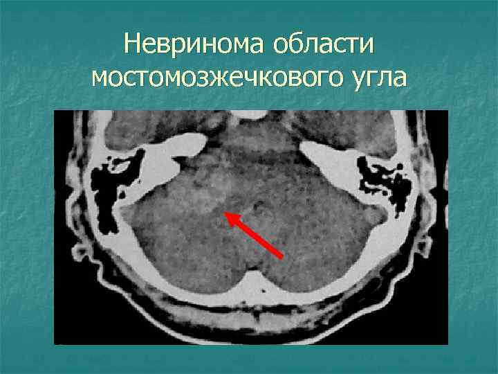 Невринома области мостомозжечкового угла 