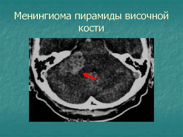 Менингиома пирамиды височной кости 