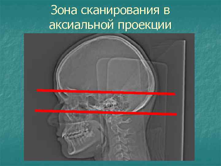 Зона сканирования в аксиальной проекции 