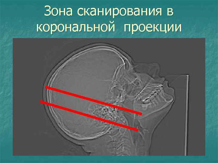 Зона сканирования в корональной проекции Зона сканирования в аксиальной проекции 