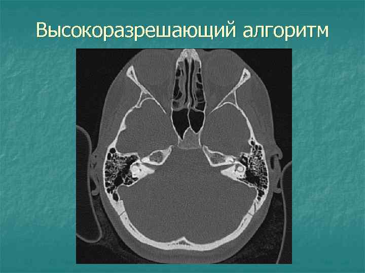 Высокоразрешающий алгоритм 