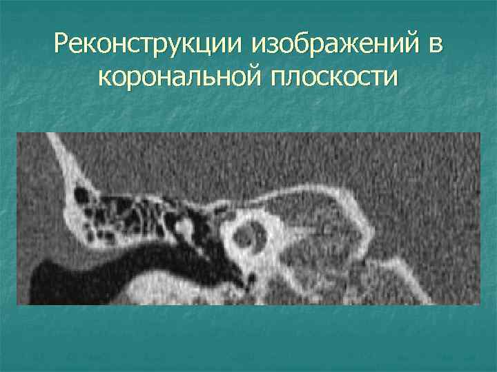 Реконструкции изображений в корональной плоскости 