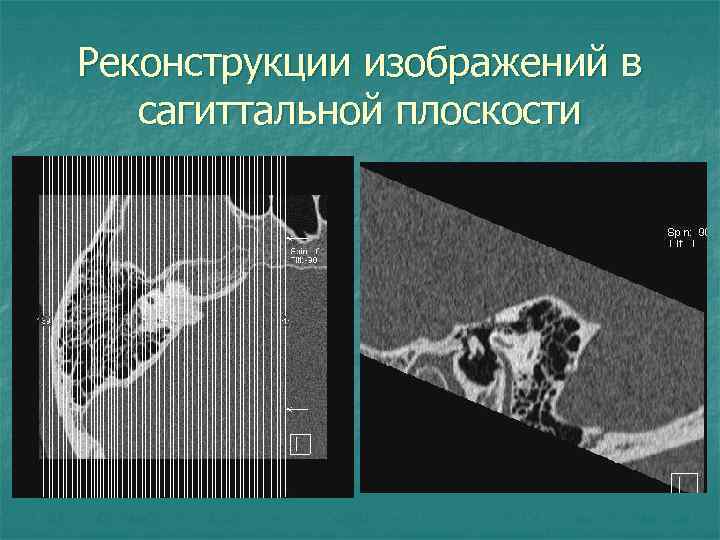 Реконструкции изображений в сагиттальной плоскости 