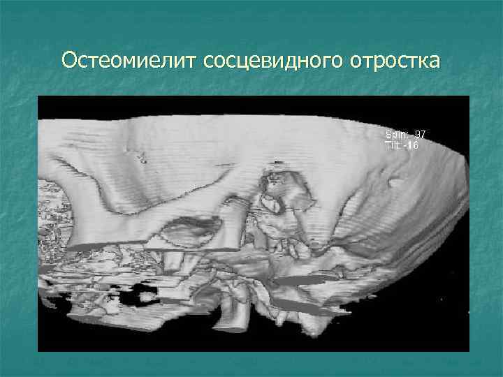 Остеомиелит сосцевидного отростка 