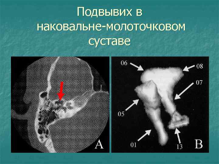 Подвывих в наковальне-молоточковом суставе 