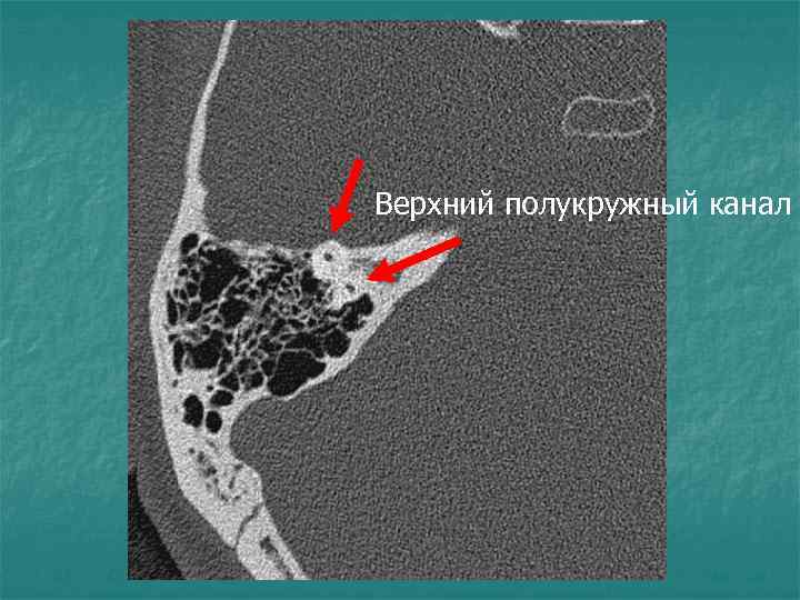 Верхний полукружный канал 