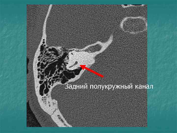 Задний полукружный канал 