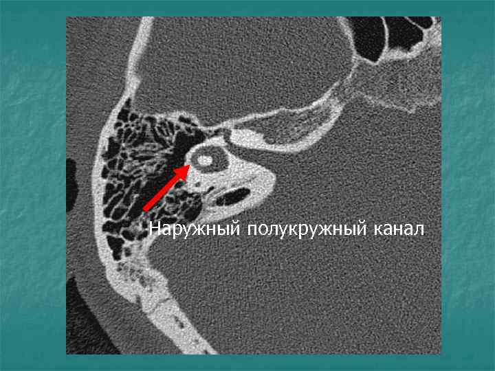 Наружный полукружный канал 