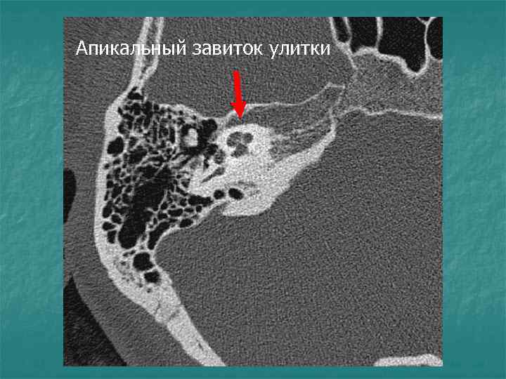 Апикальный завиток улитки 