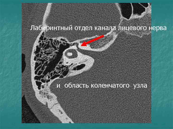 Лабиринтный отдел канала лицевого нерва и область коленчатого узла 