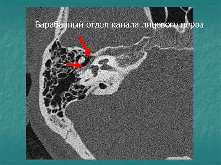 Барабанный отдел канала лицевого нерва 