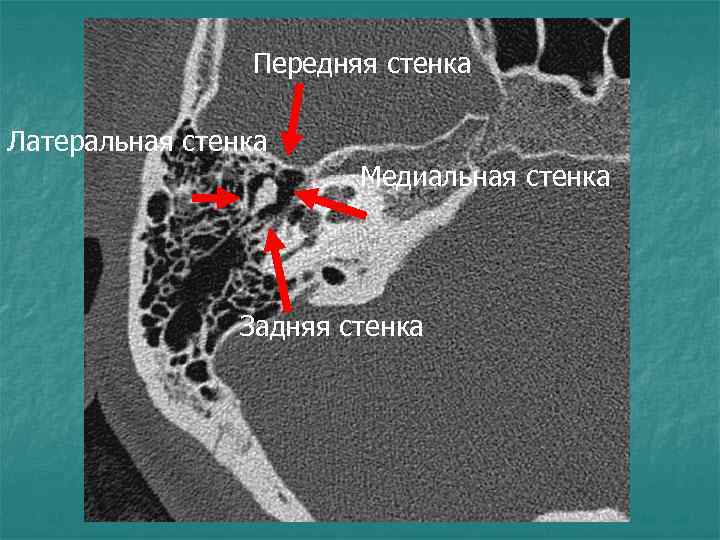 Передняя стенка Латеральная стенка Медиальная стенка Задняя стенка 