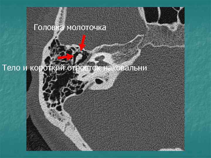 Головка молоточка Тело и короткий отросток наковальни 