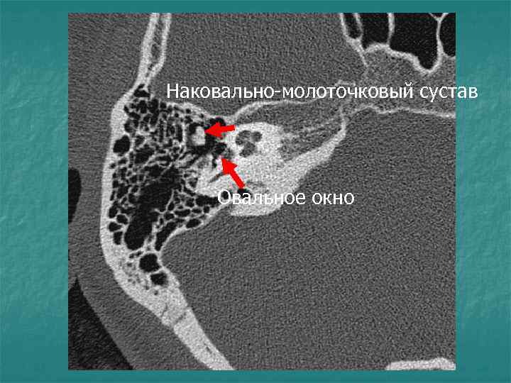 Наковально-молоточковый сустав Овальное окно 