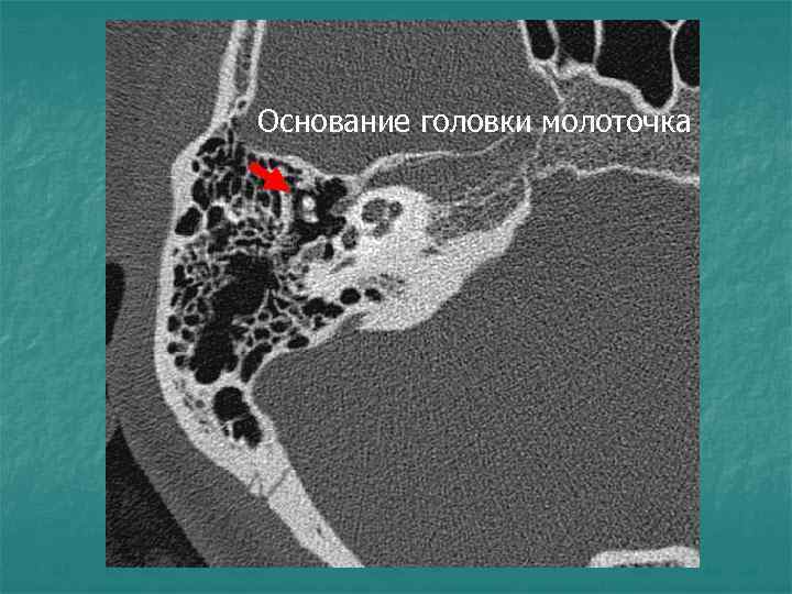 Основание головки молоточка 