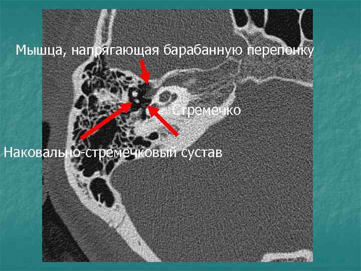 Мышца, напрягающая барабанную перепонку Стремечко Наковально-стремечковый сустав 