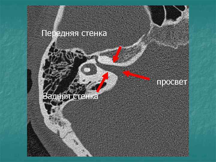 Передняя стенка просвет Задняя стенка 