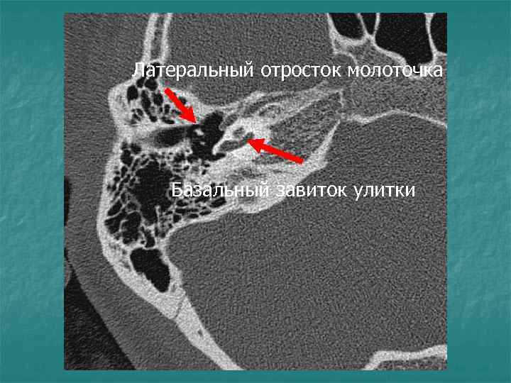 Латеральный отросток молоточка Базальный завиток улитки 